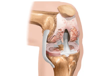 Arthritis or arthritis