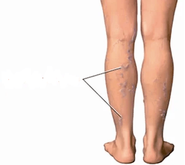 Consequences of knee joints