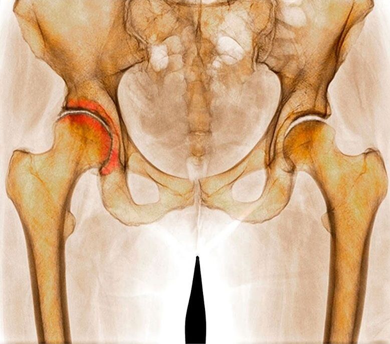 Hip arthritis