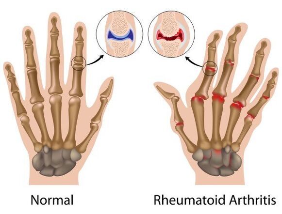 Finger joints without pathology and rheumatoid arthritis