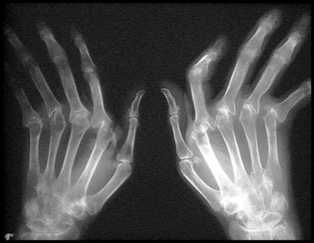 X-Picture of hands affected by joints