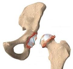 Causes of hip joint development