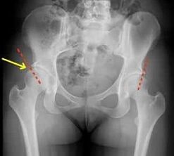 Methods for treating hip joints