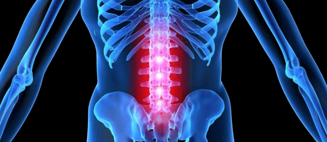 Deformation of intervertebral disc