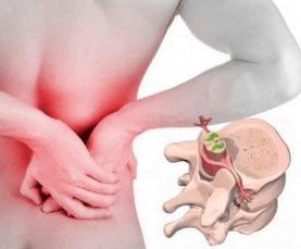 Lumbar vertebrae disease at the beginning of the disease
