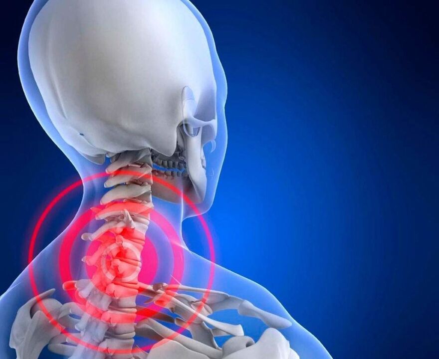 Neck pain and cervical bone and chondrochondria