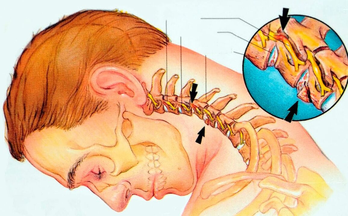 What is cervical osteochondral disease