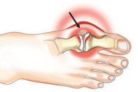 Arthritis and joint damage caused by arthritis