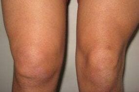 Knee joint inflammation with arthritis and arthrosis