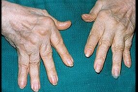 Symptoms of finger arthritis