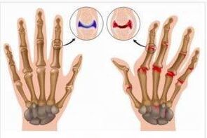 The difference between arthritis and hand joints