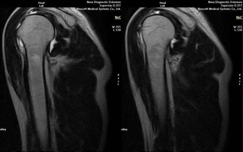Shoulder joint on x-ray