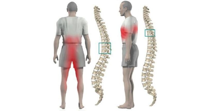 Body and spine pain with osteochondrosis