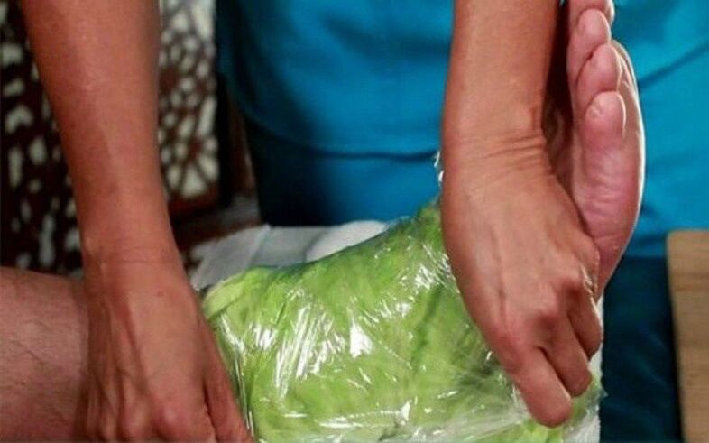 Treating Arthropathy with Cabbage Leaf Compression