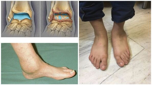 Swelling and deformation of the ankle joint caused by the joint