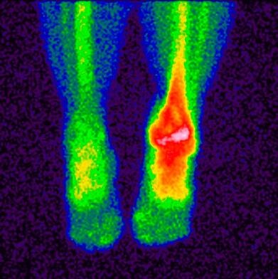 The differential diagnosis of cruciate arthropathy is scintigraphy