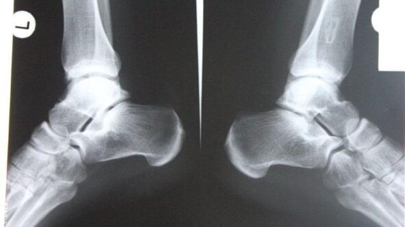 Using radiography to diagnose the ankle joint