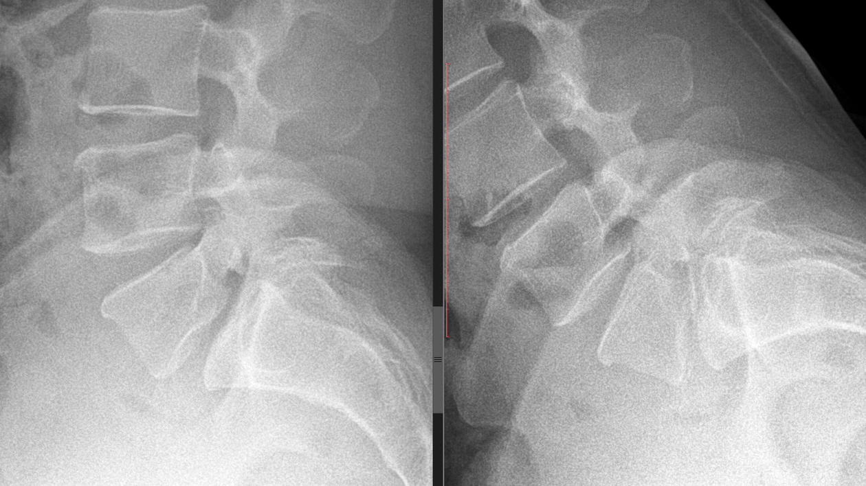 images of cervical spine