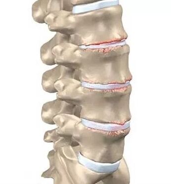 Osteochondral disease